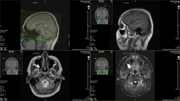 Ich Habe Aufgrund Von Unterschiedlichen Pupillen Und Schwindel Ein Mrt Bekommen Der Arzt Hatte Sich Das Bild Nur Kurz Angeschaut U Meinte Es Ware Kein Befund Gesundheit Und Medizin Medizin Augen Ich Habe Aufgrund Von Unterschiedlichen Pupillen Und Schwindel Ein Mrt Bekommen Der Arzt Hatte Sich Das Bild Nur Kurz Angeschaut U Meinte Es Ware Kein Befund Gesundheit Und Medizin Medizin Augen