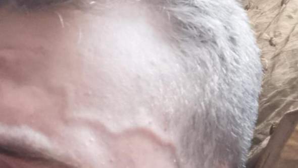 Ich Habe Dicke Und Sichtbare Adern Am Kopf Ist Das Normal Gesundheit Und Medizin Korper Adern Sichtbar Ich Habe Dicke Und Sichtbare Adern Am Kopf Ist Das Normal Gesundheit Und Medizin Korper Adern Sichtbar