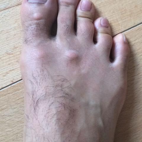 Rechter Fuß
 - (Schuhe, Füße, druckstellen)