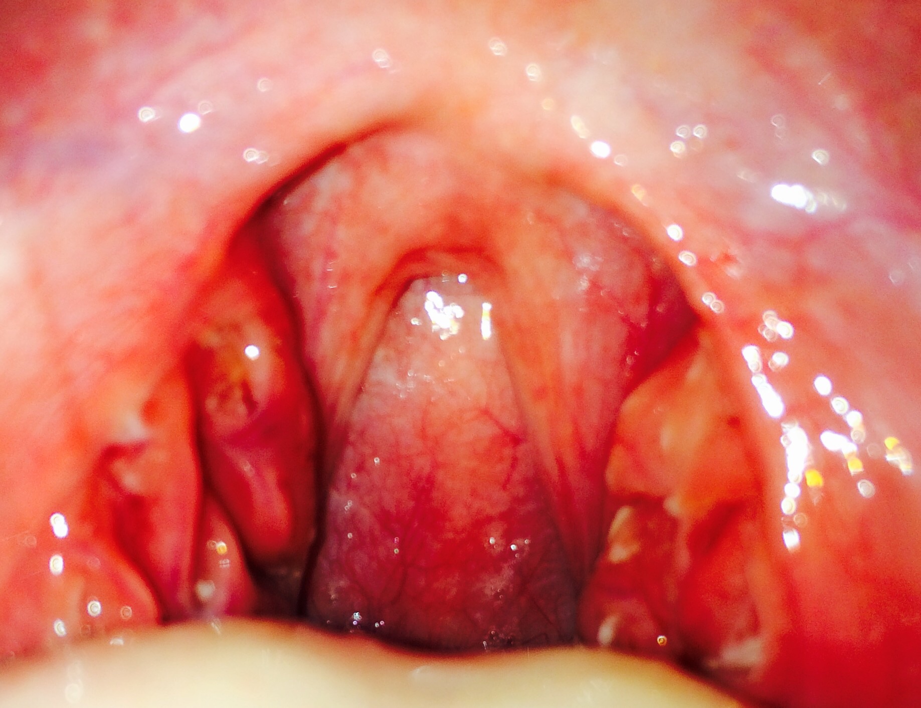 Ich habe eig gedacht ich habe eine Mandelentzündung aber in meinen Ich habe eig gedacht ich habe eine Mandelentzündung aber in meinen