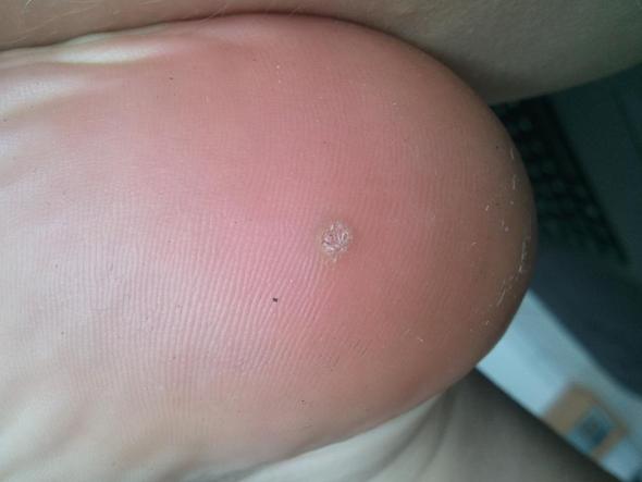 Ich Habe Eine Komische Warzen Am Fuss Korper Ferse Ich Habe Eine Komische Warzen Am Fuss Korper Ferse