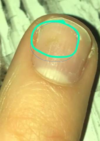 ich habe eine leicht grunliche verfarbung am nagel nachdem ich eine woche kunst nagel getragen hatte was kann das sein fingernagel