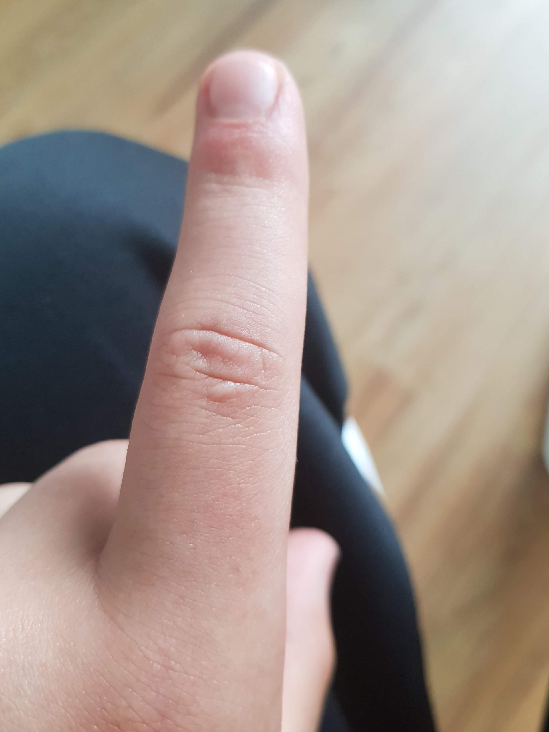 Ich habe eine Schwellung am rechten Zeige finger seit 1 jahr