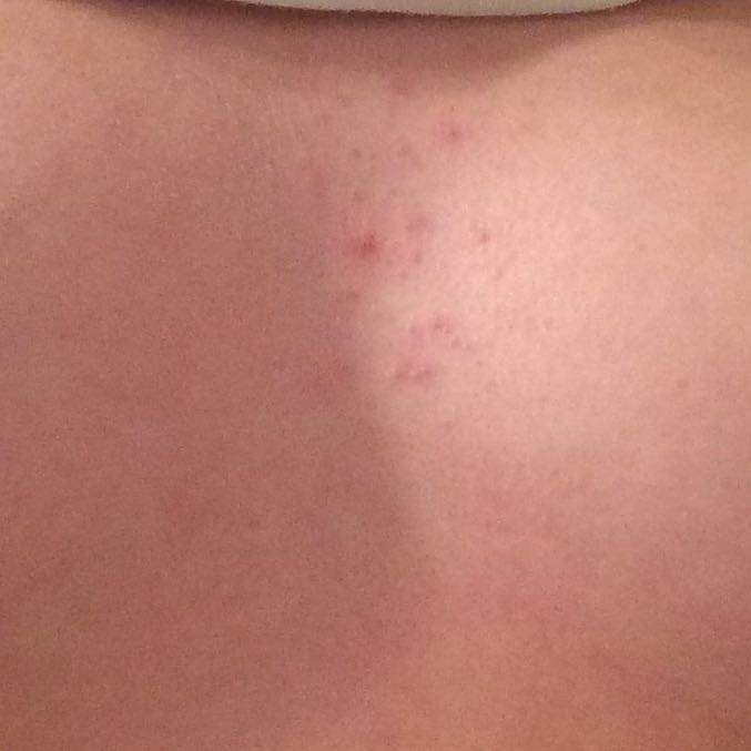 Ich Habe Einen Ausschlag Zwischen Der Brust Nirgendwo Anderes Nur Da Seit Ca 1 Woche Kleine Rote Hugel Ich Habe Einen Ausschlag Zwischen Der Brust Nirgendwo Anderes Nur Da Seit Ca 1 Woche Kleine Rote Hugel