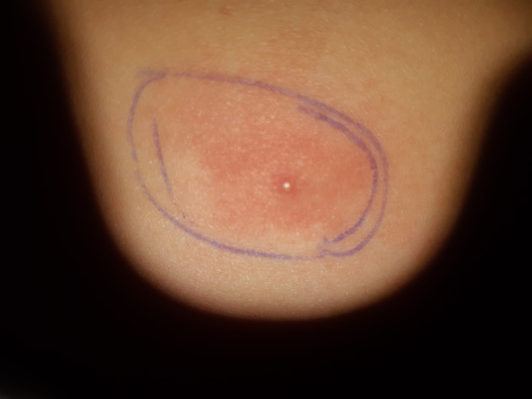 Ich Habe Einen Pickel Auf Dem Bauch Der Ziemlich Entzunden Ist Ist Das Schlimm Haut Ich Habe Einen Pickel Auf Dem Bauch Der Ziemlich Entzunden Ist Ist Das Schlimm Haut