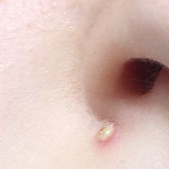 Ich Habe Einen Pickel Was Soll Ich Tun Damit Er Schnell Weg Ist Ausdrucken Madchen Beauty Tipps