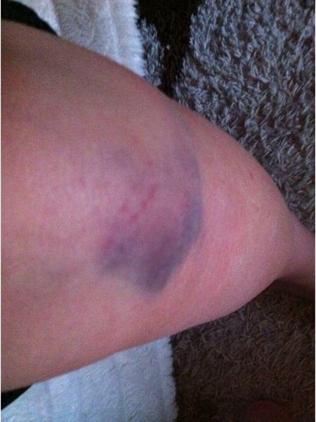 Ich habe einen riesigen Bluterguss am Kniegelenk! (Knie)