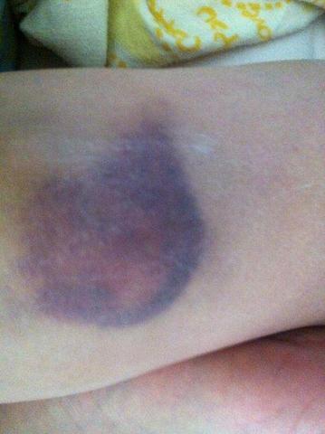 Ich Habe Einen Riesigen Bluterguss Am Kniegelenk Knie Ich Habe Einen Riesigen Bluterguss Am Kniegelenk Knie