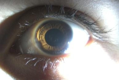 Ich Habe Einen Ring Um Die Iris Ist Es Normal Man Sieht Es Nur Bei Licht Augen Ich Habe Einen Ring Um Die Iris Ist Es Normal Man Sieht Es Nur Bei Licht Augen