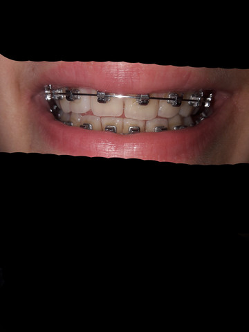 Meine Zähne  - (Gesundheit und Medizin, Zähne, Zahnspange)