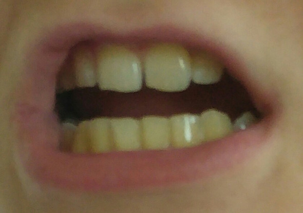 Hier ein Bild von meinen Zähnen. - (Zähne, Zahnpflege, Mundhygiene)