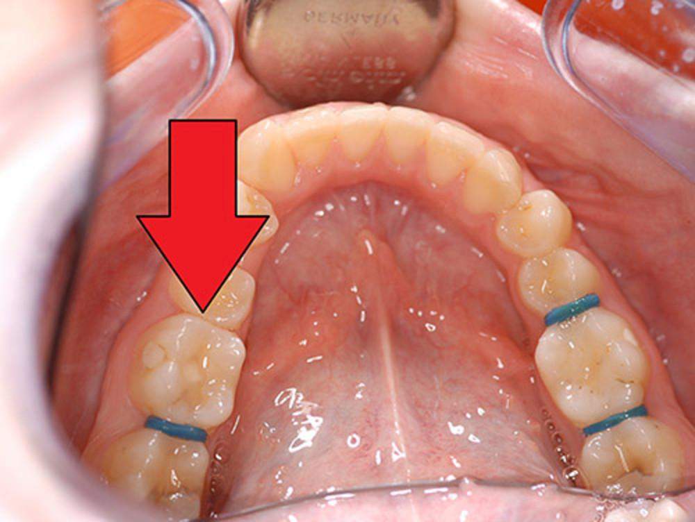 Ich habe gestern Gummis zwischen meine Zähne bekommen, darf ich damit ...
