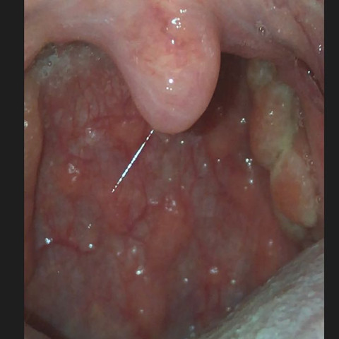 Ich Habe Halsschmezen Mit Komischen Grunen Schleim Hinten Im Rachen Bei Den Atemwegen Ist Der Schleim Die Ursache Fur Die Halsschmerzen Ich Habe Halsschmezen Mit Komischen Grunen Schleim Hinten Im Rachen Bei Den Atemwegen Ist Der Schleim Die Ursache Fur Die Halsschmerzen