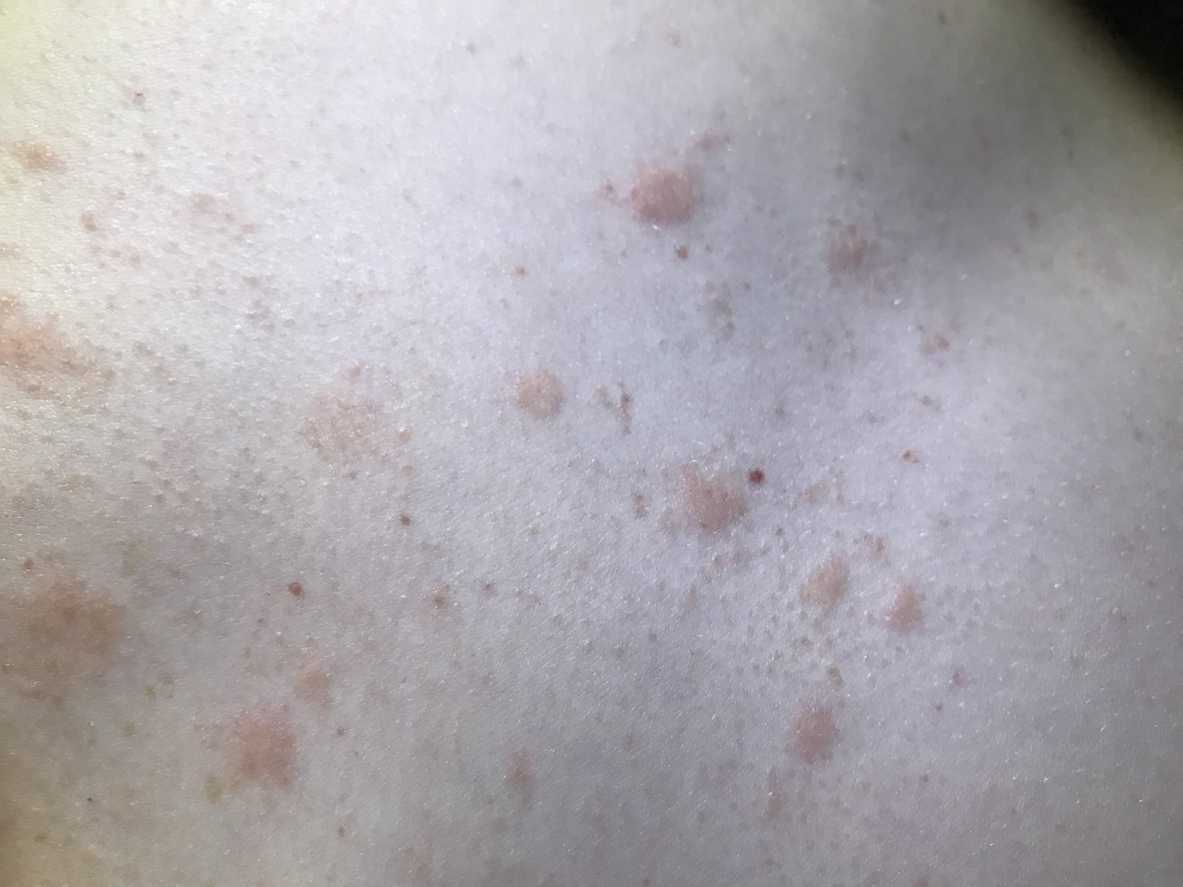 Ich habe jede Menge kleiner Roter Punkte auf der Brust und dem Rücken (Bild ist im Anhang? (Arzt pickel auf brust