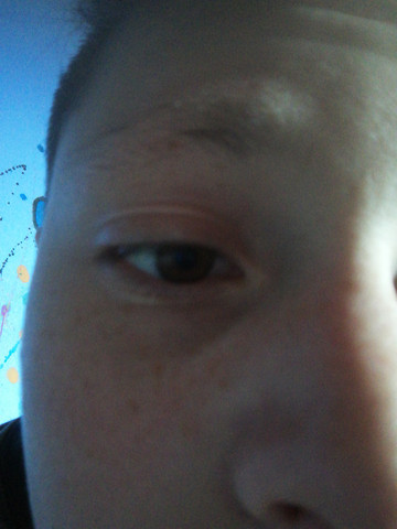 Ich Habe Keine Augenbrauen Medizin Haare Haut