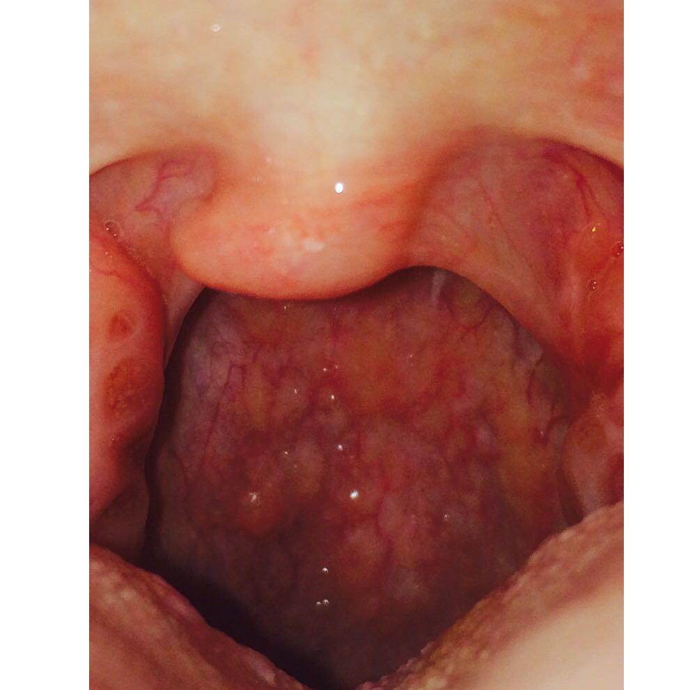 Angina - Mandelentzündung - Symptome