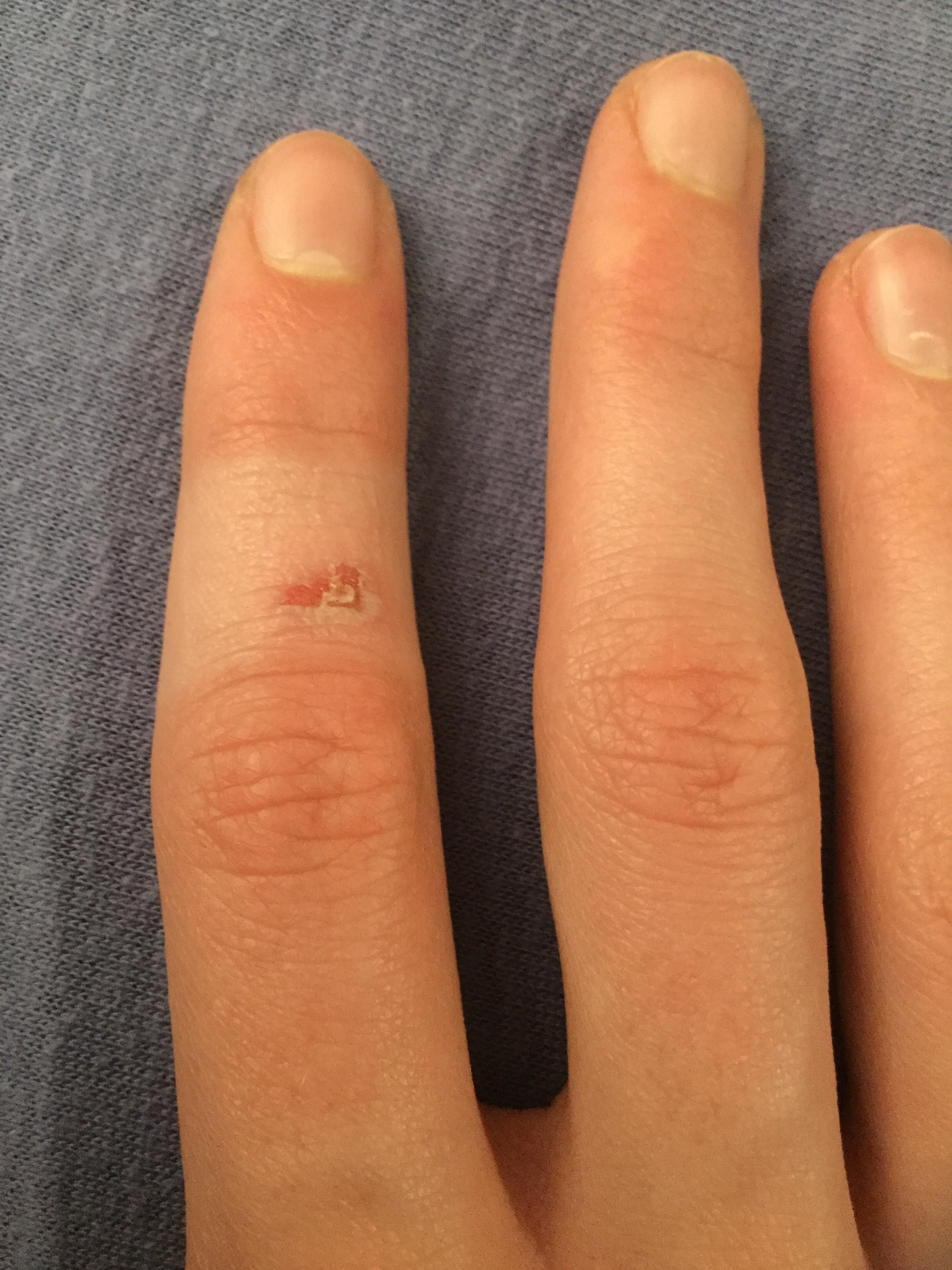 Ich habe meinen Finger verbrannt und nach 2 Tagen habe ich ein Pflaster
