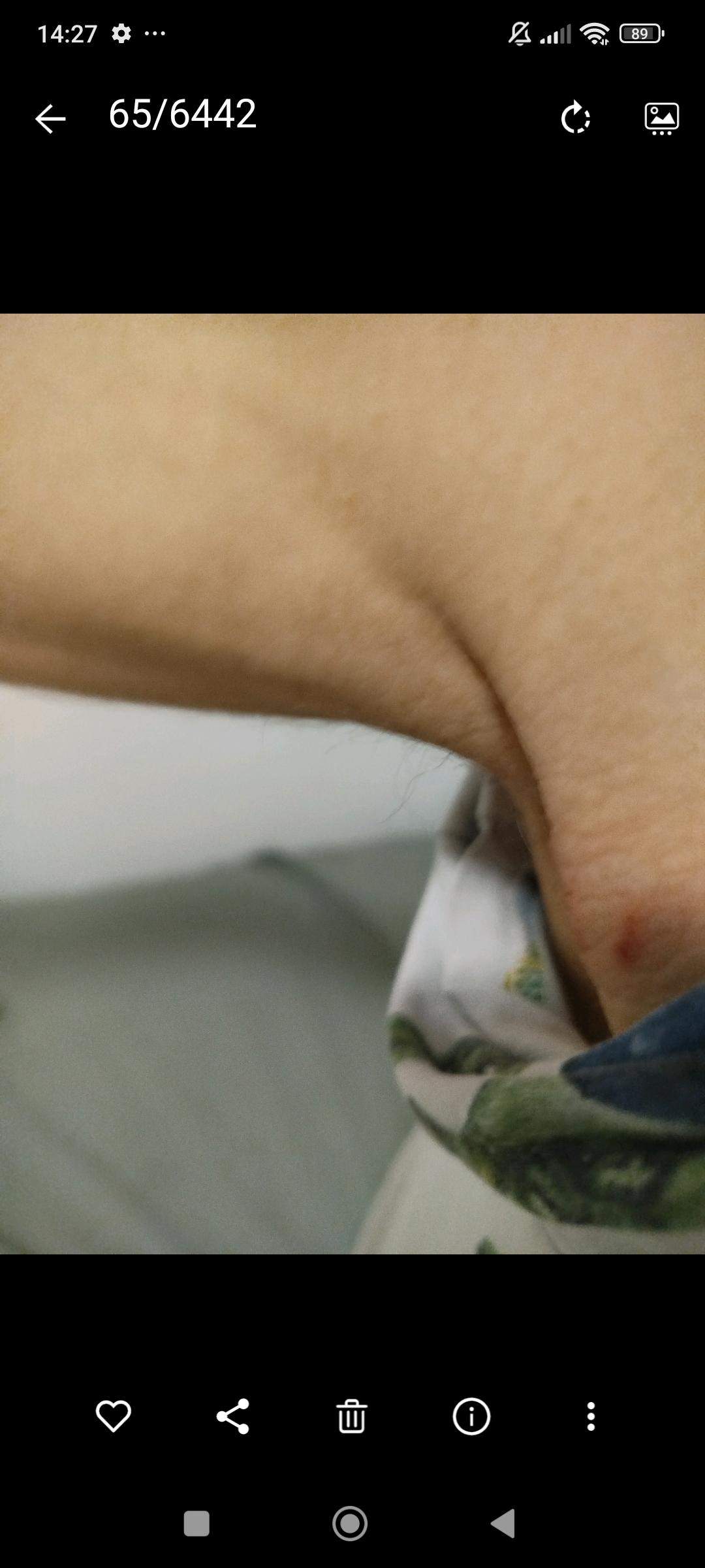 Ich habe mich bei Axeln rasieren verletzt? (Verletzung, Rasierer, Achseln)