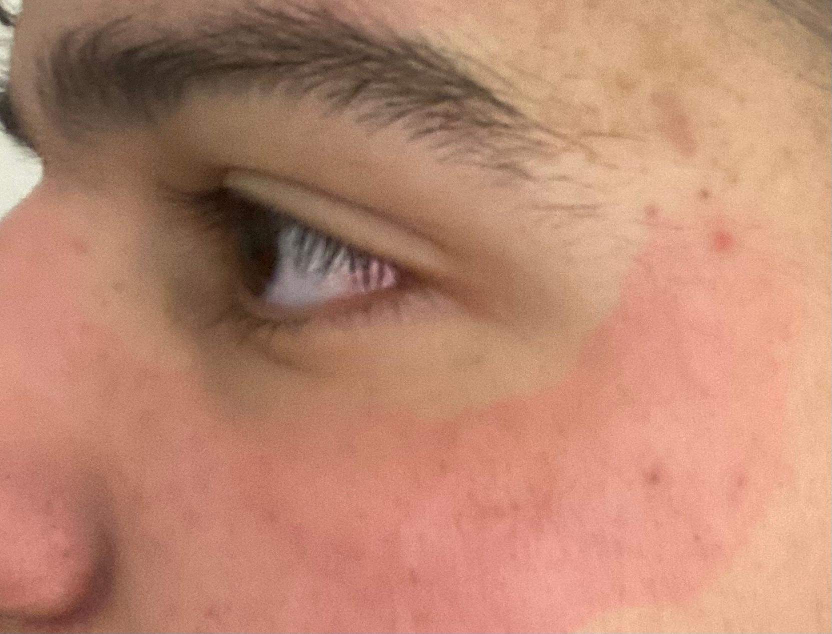 Ich habe nach einer Maske ein Gesicht eine rote Gesicht wie geht es weg Hilfe?