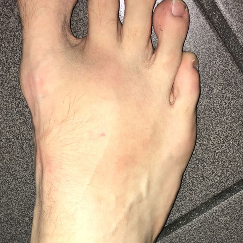 blauer fleck am fuß