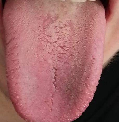 Auf weißes zunge ding der Zungenbelag: verhindern