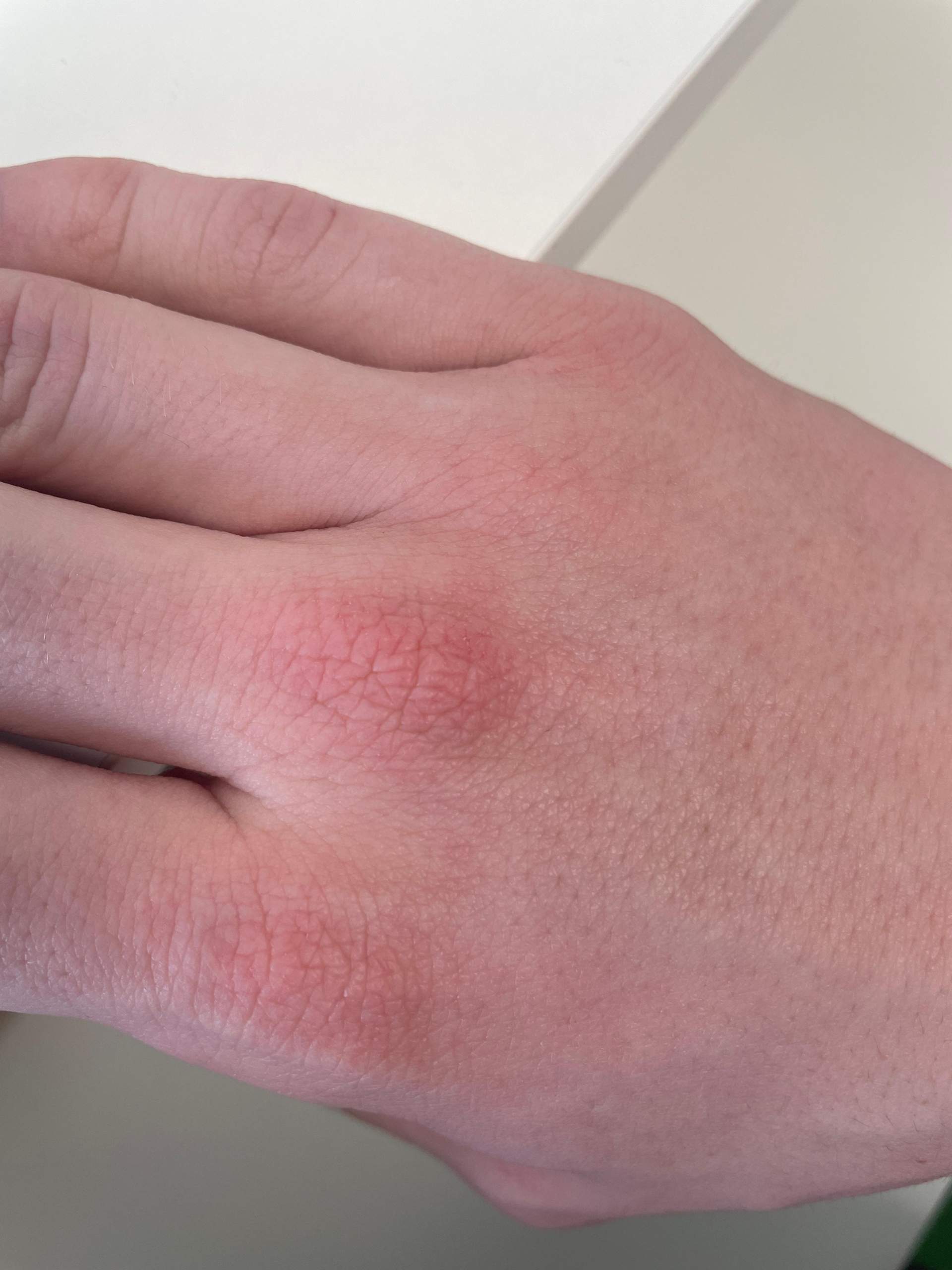 Ich habe rote Flecken auf Handrücken, was jemand was das ist ...