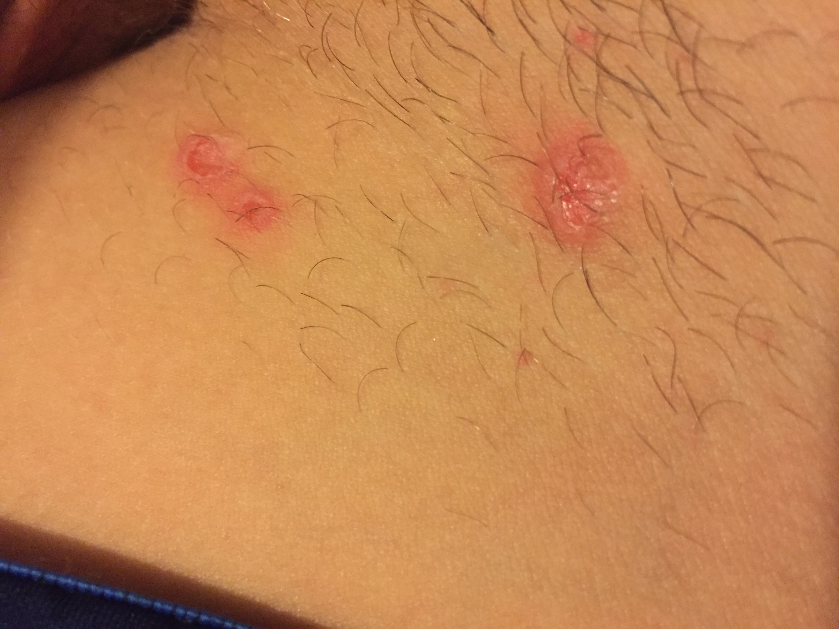 ich habe rote pickel im intimbereich