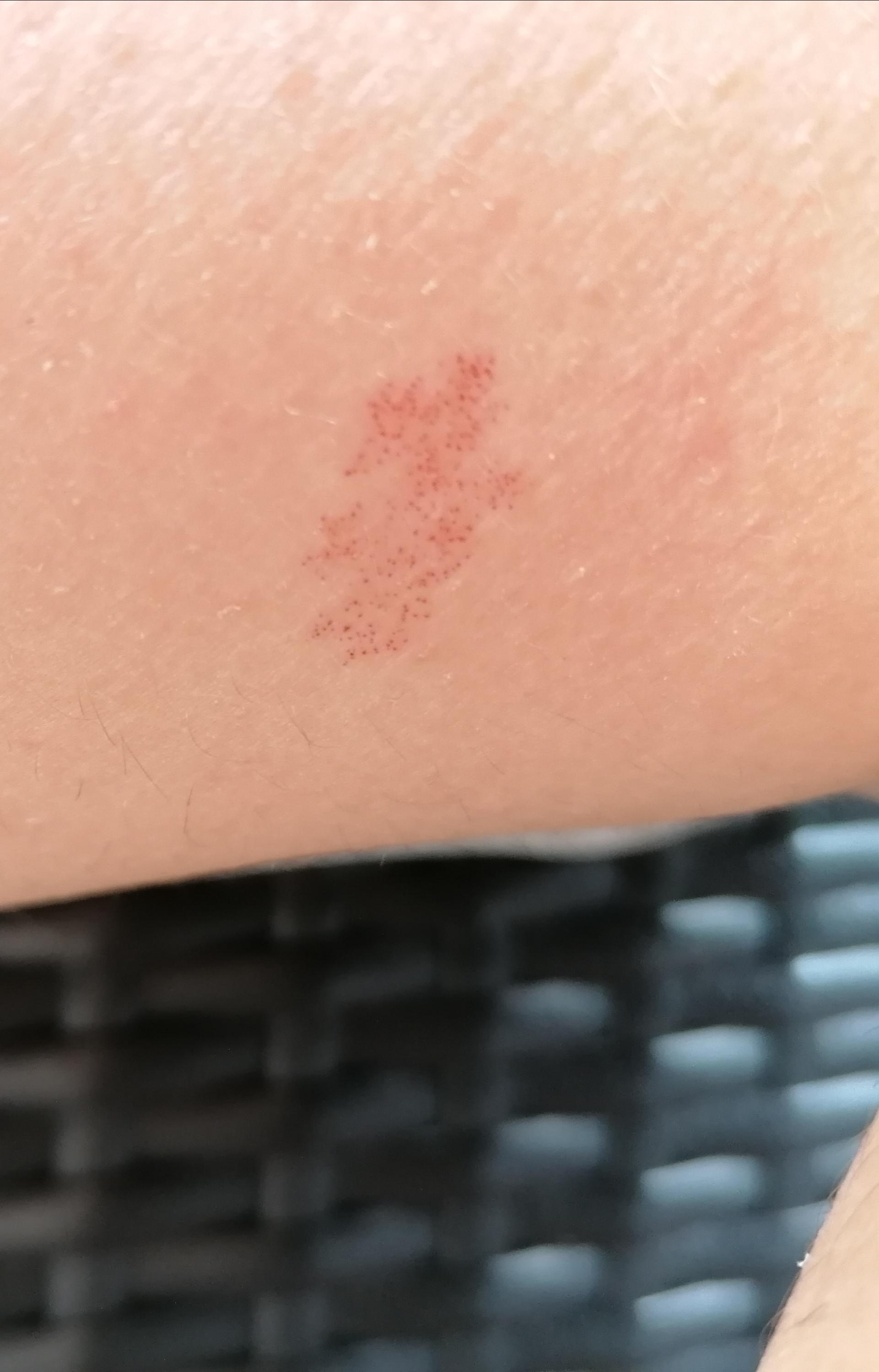 Ich Habe Rote Punkte Am Bein Kann Mir Jemand Helfen Haut Hilflos Hautprobleme