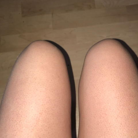 Ich Habe Rote Punkte Auf Den Beinen Was Ist Das Was Kann Man Dagegen Tun Dass Sie Nicht So Auffallen Gesundheit Und Medizin Haut Sommer