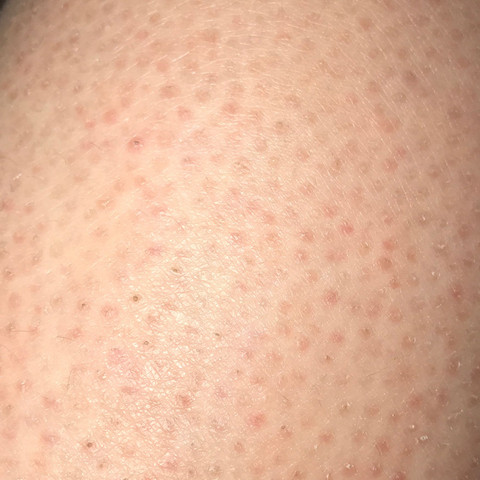 Ich Habe Rote Punkte Auf Den Beinen Was Ist Das Was Kann Man Dagegen Tun Dass Sie Nicht So Auffallen Gesundheit Und Medizin Haut Sommer