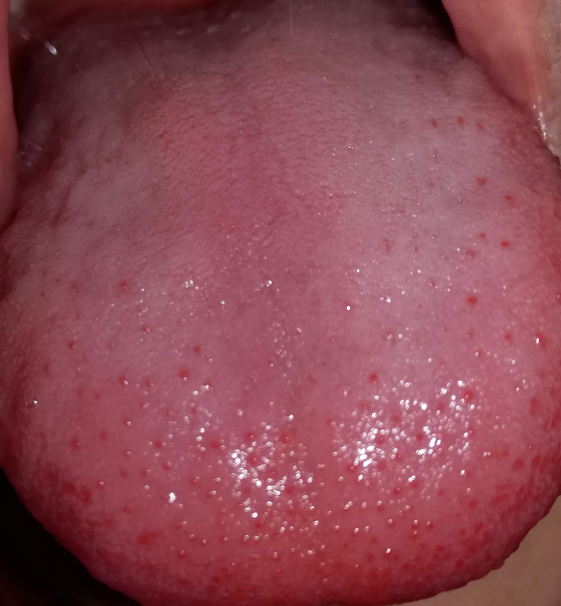 Ich Habe Rote Punkte Auf Der Zunge Was Haben Diese Zu Bedeuten Gesundheit Und Medizin Arzt Mund Ich Habe Rote Punkte Auf Der Zunge Was Haben Diese Zu Bedeuten Gesundheit Und Medizin Arzt Mund
