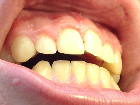 Einmal sind es Punkte auf dem 2. von links, einmal zwischen den Mittleren - (Zähne, Zahnarzt, Zahnpflege)