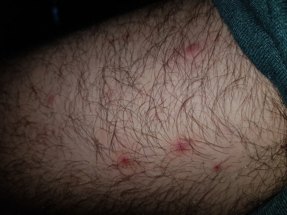 Ich Habe Seit Einiger Zeit Viele Pickel Auf Dem Oberschenkel Siehe Foto Gesundheit Und Medizin Sport Sport Und Fitness Ich Habe Seit Einiger Zeit Viele Pickel Auf Dem Oberschenkel Siehe Foto Gesundheit Und Medizin Sport Sport Und Fitness