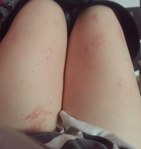 Ich Habe Seit Gestern Rote Juckende Pickel Auf Der Haut Sie Sind Am Ganzen Korper Verteilt Weiss Jemand Was Das Fur Welche Sind Hautausschlag