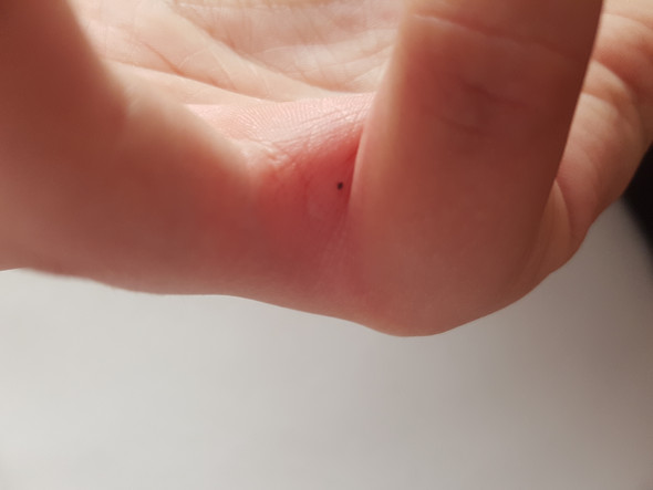 Ich Habe Seit Heute Einen Rotlichenbraunlichen Punkt Zwischen Ring Und Kleinen Finger Es Juckt Und Ist Leicht Angeschwollen Wss Kann Das Sein Gesundheit Hautprobleme Hautkrebs Ich Habe Seit Heute Einen Rotlichenbraunlichen Punkt Zwischen Ring Und Kleinen Finger Es Juckt Und Ist Leicht Angeschwollen Wss Kann Das Sein Gesundheit Hautprobleme Hautkrebs