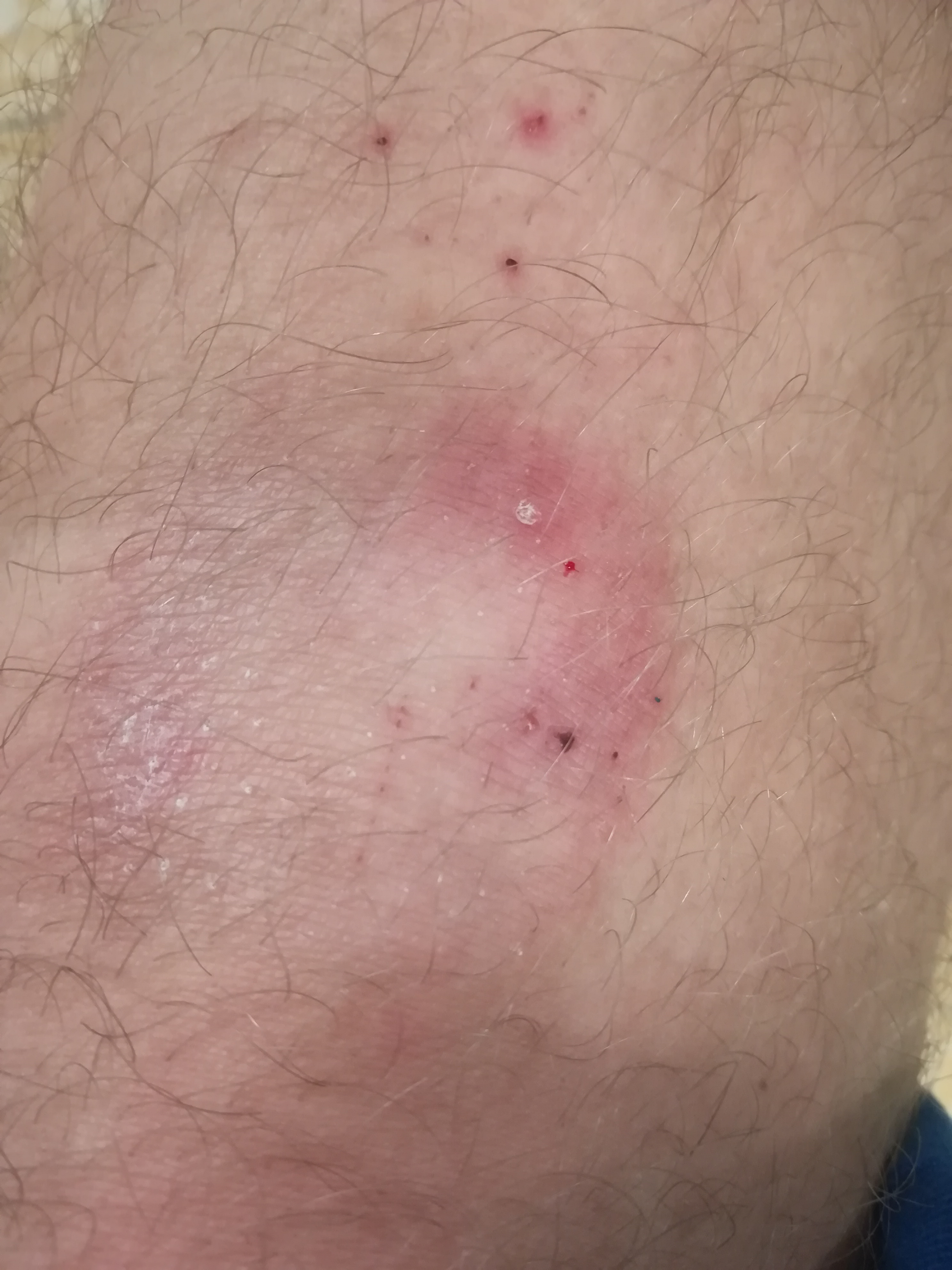 Ich Habe Seit Uber 2 Monaten Ein Roten Fleck Unter Dem Knie Was Ist Es Gesundheit Und Medizin Allergie Flecken Ich Habe Seit Uber 2 Monaten Ein Roten Fleck Unter Dem Knie Was Ist Es Gesundheit Und Medizin Allergie Flecken