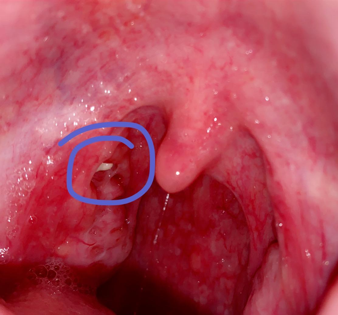 Ich Habe So Einen Weissen Fleck Im Mundraum Was Konnte Es Sein Kann Es Auch Mundkrebs Oder Rachenkrebs Sein Zudem Sind Meine Mandeln Schon Seit Sehr Langer Gesundheit Und Medizin Krankheit Flecken Ich Habe So Einen Weissen Fleck Im Mundraum Was Konnte Es Sein Kann Es Auch Mundkrebs Oder Rachenkrebs Sein Zudem Sind Meine Mandeln Schon Seit Sehr Langer Gesundheit Und Medizin Krankheit Flecken