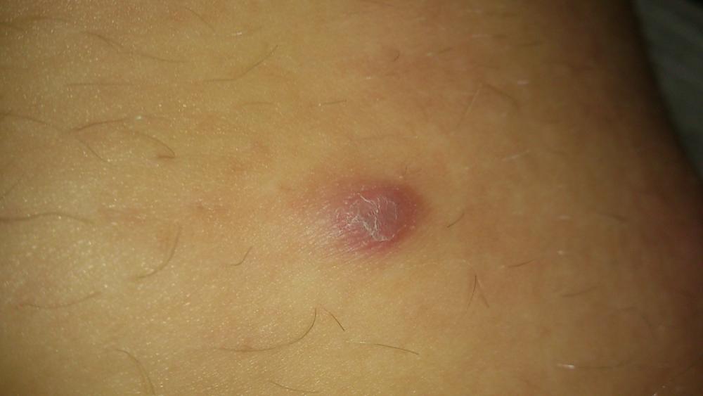 Ich habe so merkwürdige lila pickel an meiner inneren oberschenkelseite (Medizin, Körper) pickel an oberschenkel