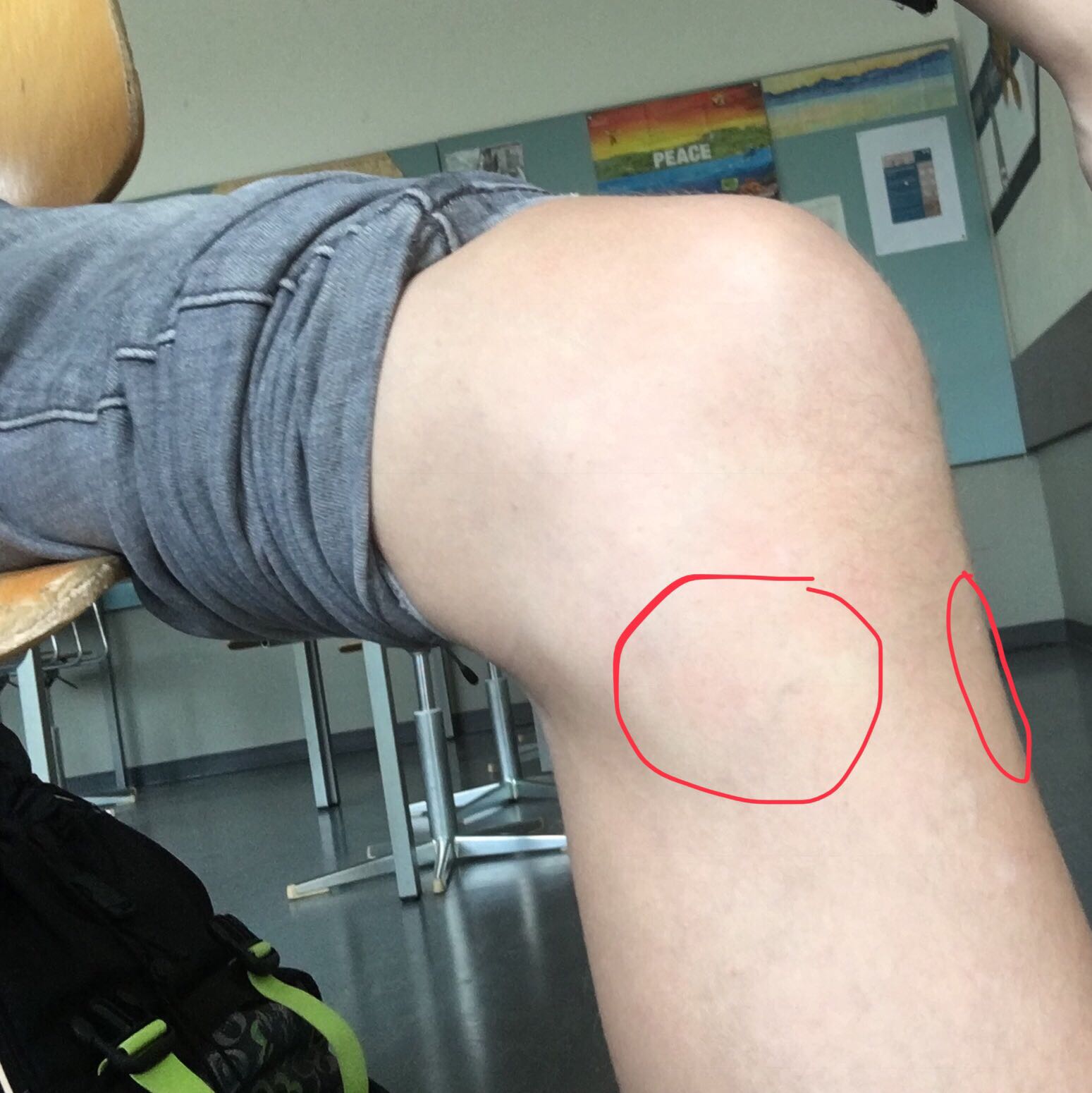 46++ Gicht im knie bilder , Ich habe solche Schmerzen an meinem Knie? (Gesundheit und Medizin