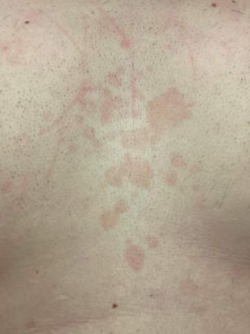 Ich Habe Zwischen Meiner Brust Ein Paar Rote Flecken Habe Diese Schon Langer Weiss Jemand Was Diese Zu Bedeuten Haben Gesundheit Und Medizin Gesundheit Ich Habe Zwischen Meiner Brust Ein Paar Rote Flecken Habe Diese Schon Langer Weiss Jemand Was Diese Zu Bedeuten Haben Gesundheit Und Medizin Gesundheit