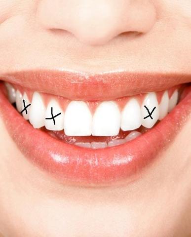 Zähne - (Zähne, Zahnspange, Zahnlücke)