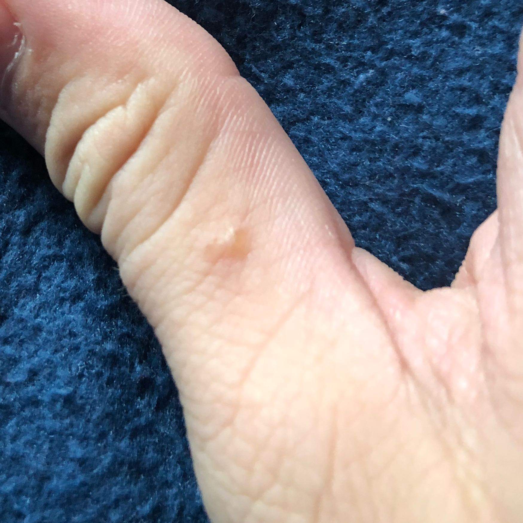 Ich hatte Krätze und habe sie auch behandelt, es ist jetzt ungefähr 4-5 Tage her und es haben pickel hand