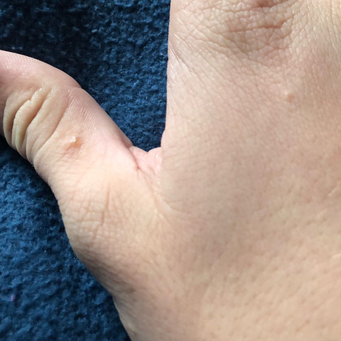 Ich Hatte Kratze Und Habe Sie Auch Behandelt Es Ist Jetzt Ungefahr 4 5 Tage Her Und Es Haben Sich Neue Pickel Usw Gebildet Ist Das Normal Gesundheit Und Medizin Kratzebehandlung Ich Hatte Kratze Und Habe Sie Auch Behandelt Es Ist Jetzt Ungefahr 4 5 Tage Her Und Es Haben Sich Neue Pickel Usw Gebildet Ist Das Normal Gesundheit Und Medizin Kratzebehandlung