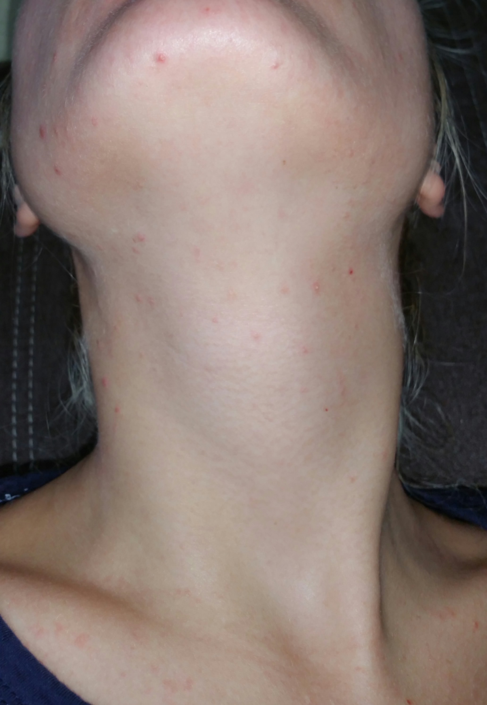 Sind die Pusteln an meinem Hals Akne oder eine Allergie? (Pickel)