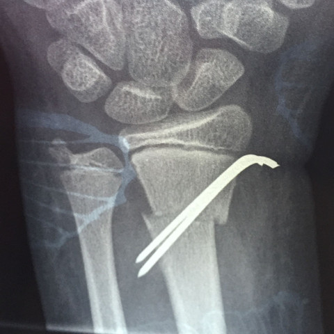 Meine Hand nach der Operation - (Operation, Finger, Bruch)