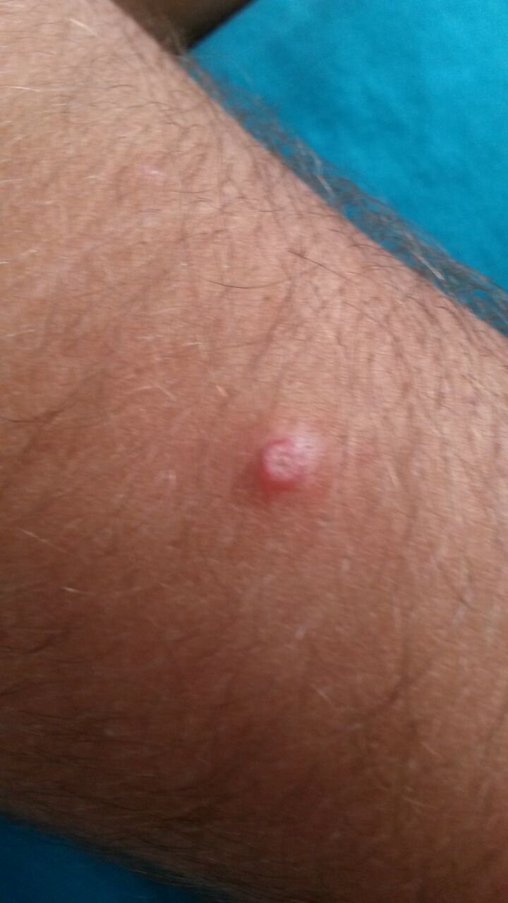 Was ist das für ein komisches Ding auf meinem Arm? (Hautkrebs)