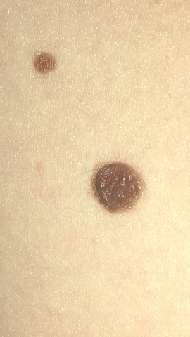 Ich Vermute Dass Ich Schwarzen Hautkrebs Habe Gehe Demnachst Zum Arzt Hat Wer Erfahrung Damit Ich Meine Die Symptome Krebs Melanom Ich Vermute Dass Ich Schwarzen Hautkrebs Habe Gehe Demnachst Zum Arzt Hat Wer Erfahrung Damit Ich Meine Die Symptome Krebs Melanom