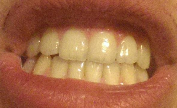 Hässliche Zähne - (Zähne, gelbe Zähne)