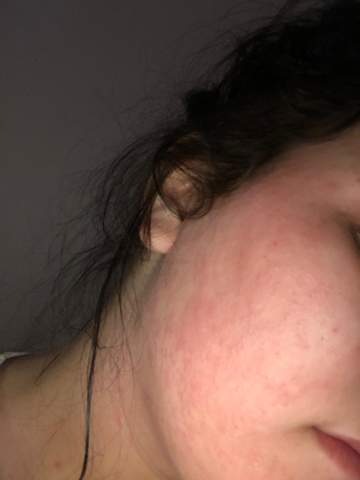 Ich War Gestern Feiern Und Habe Auch Alkohol Getrunken Jetzt Habe Ich Starken Ausschlag Im Gesicht Und Dekolte Pustel Formig Habt Ihr Erfahrung Mit Ausschlag Gesundheit Und Medizin Hautpflege Ich War Gestern Feiern Und Habe Auch Alkohol Getrunken Jetzt Habe Ich Starken Ausschlag Im Gesicht Und Dekolte Pustel Formig Habt Ihr Erfahrung Mit Ausschlag Gesundheit Und Medizin Hautpflege