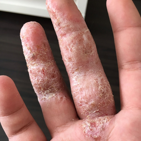 Das sind meine 2 Finger  - (Gesundheit und Medizin, Haut, Finger)